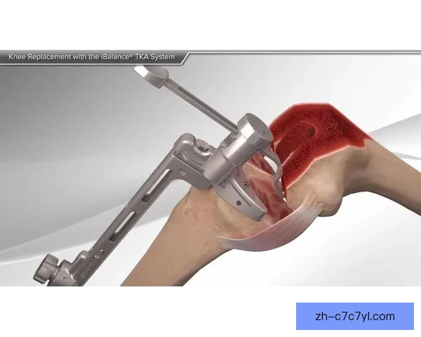 万幸!髌腱撕裂手术可恢复膝关节 万幸!髌腱撕裂手术可恢复膝关节